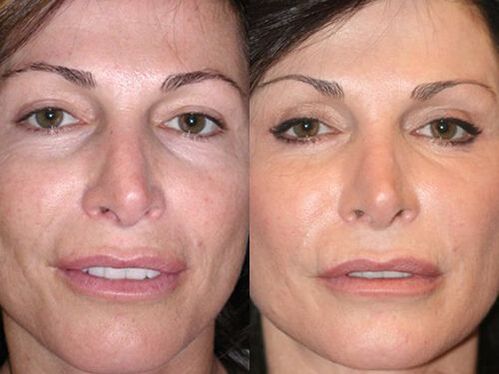 преди и след подмладяване на плазмената кожа