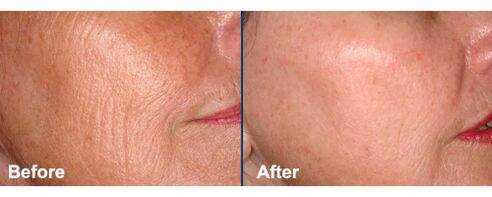 Кожа на лицето преди и след процедура за лазерно подмладяване