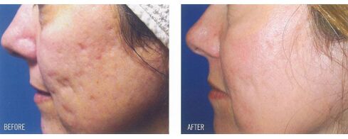Преди и след прилагане на лазерното устройство върху кожата с белези