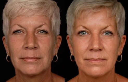 Резултат от лазерно третиране на кожата на лицето - намаляване на бръчките