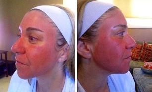Зачервяване на лицето след лазерно подмладяване