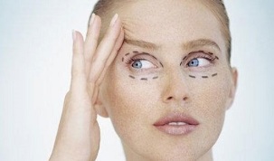 видове блефаропластика за подмладяване на кожата около очите
